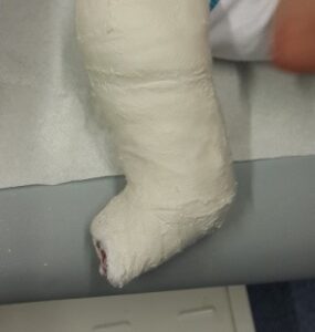 Pes equinovarus 5