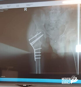 Kristijan e dete so mnogu teshka forma na Autizam i Epilepsija 005