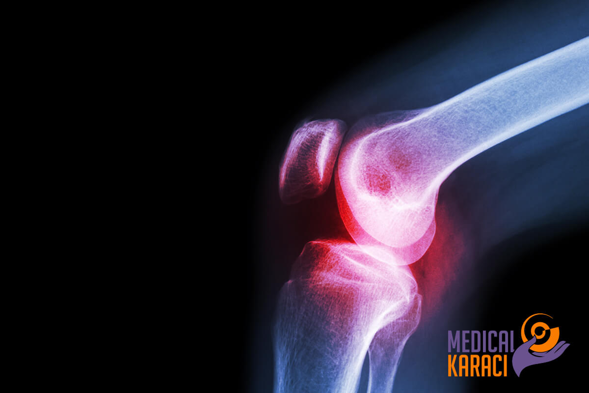 osteoarthritis időseknél erős fájdalom a térd alatt mögött mi ez