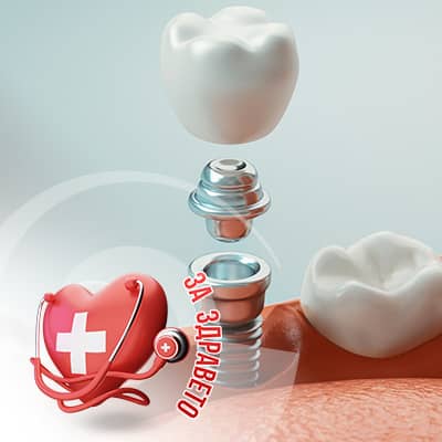 зъбните импланти