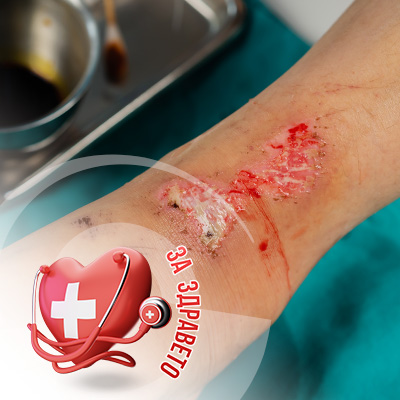 хронични рани